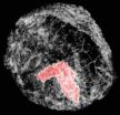 Breakthrough technique images breast tumors in 3-D with great clarity, reduced radiation