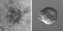 Breast cancer cells enticed to spread by tumorous environment as well as genetic changes