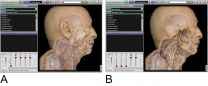 Cadavers beat computers for learning anatomy