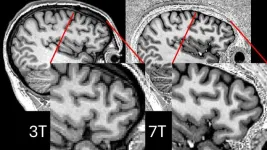 Cambridge team uses powerful new MRI scans to enable life-changing surgery in first for adults with epilepsy