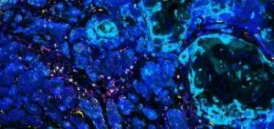 Carcinogen-exposed cells provide clues in fighting treatment-resistant cancers