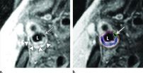 Carotid Artery MRI helps predict likelihood of strokes and heart attacks 2