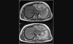 Case Report: Intrathoracic synovial sarcoma with BRAF V600E mutation