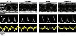 Cause of heart failure may differ for women and men 2