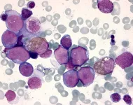 Cause of leukemia in trisomy 21