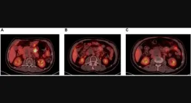 CDK9 Inhibitors: A promising combination partner in treating hematological malignancies