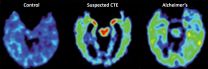 Characteristic pattern of protein deposits in brains of retired NFL players who suffered concussions