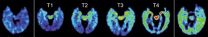 Characteristic pattern of protein deposits in brains of retired NFL players who suffered concussions 2