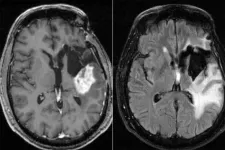 Chemo for glioblastoma may work better in morning than evening