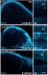 Cholesterol accumulation contributes to genetic movement disorder