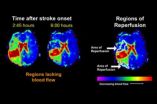 Cholesterol drugs may improve blood flow after stroke 