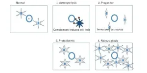 Classification scheme developed for newly identified multiple sclerosis-like disease