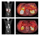 Combination targeted treatment produces lasting remissions in people with resistant aggressive B-cell lymphoma