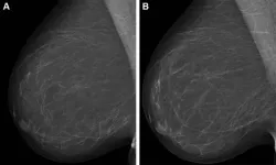 Combining AI models improves breast cancer risk assessment