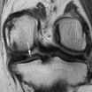 Common knee surgery may lead to arthritis and cartilage loss 2