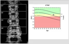 Common thyroid medicine linked to bone loss