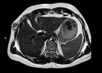 Complete response to encorafenib + binimetinib in BRAF V600E-mutant tumor