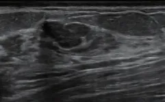 Computer‐aided diagnosis improves breast ultrasound expertise in multicenter study