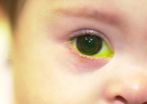 Contacts better than permanent lenses for babies after cataract surgery