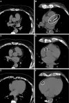 Coronary artery calcium score predictive of heart attacks, strokes