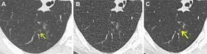 COVID-19 discovery opens door to new treatments for chronic lung problems 2