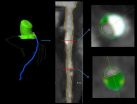 CT angiography links arterial plaque with diabetes, blood pressure, cholesterol 2