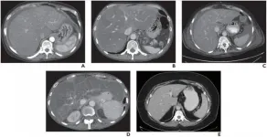 CT identifies patients with high-risk nonalcoholic fatty liver disease (NAFLD)