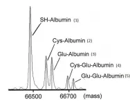 Cysteinylated albumin: A new early diagnostic marker for diabetic kidney disease