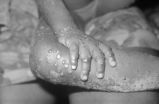 Deadly monkeypox virus might cause disease by breaking down lung tissue