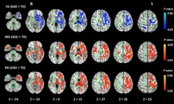 Decoding autism through neuroimaging: how alterations in brain connectivity shape symptoms