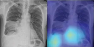 Deep-learning chest radiograph model predicts mortality for community-acquired pneumonia