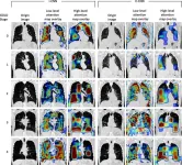 Deep learning model accurately diagnoses COPD