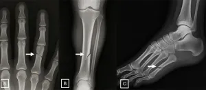 Deepfake x-rays fool radiologists and AI 2