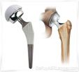 DePuy ASR Hip Recall Announced Long After Reports of High Revision Rates and Metal Ion Release in Patients; Depuy ASR Hip Lawyers Offer Free Claim Evaluations for Patients Nationwide 2