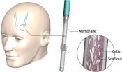 Device implanted in brain has therapeutic potential for Huntingtons disease