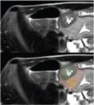 Diagnosing pediatric Crohn disease with radiomic and clinical data