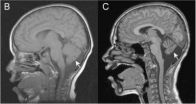 Diagnostic criteria for Christianson Syndrome