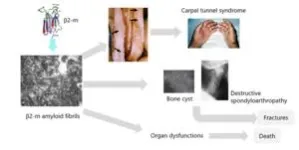 Discovery of proteins associated with the progression of dialysis-related amyloidosis 2