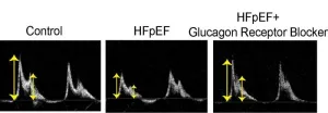 Duke-NUS study proposes new heart failure treatment targeting abnormal hormone activity