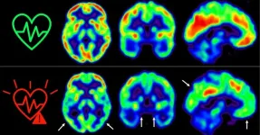 Early action to control cardiovascular risk factors preserves brain metabolism