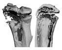 Emerging cancer drugs may drive bone tumors