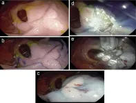 Endoscopic treatment approaches for inflammatory bowel diseases: old friends and new weapons