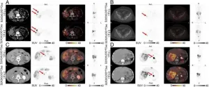 Expanded PET imaging time window adds flexibility for neuroendocrine tumor patients