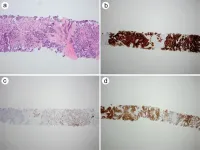 Expression of carbonic anhydrase IX as a novel diagnostic marker for differentiating pleural mesothelioma from non-small cell lung carcinoma