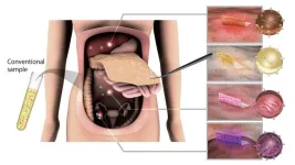 Extracellular vesicles captured using sustainable wood celluose-based nanofiber sheets may identify and improve cancer treatment