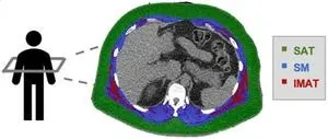 Fatty muscles raise the risk of serious heart disease regardless of overall body weight 2