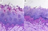 Fighting for oral dominance: Good fungi keep bad ones in check in healthy mouths