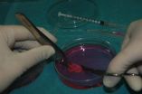 First live birth after transplantation of ovarian tissue frozen during childhood 2