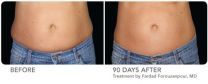 First Plastic Surgeon in Scottsdale / Phoenix Arizona to Offer CoolSculpting to Reduce Fat Bulges 3