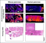 For the first time, researchers detect pre-malignant pancreatic lesions with magnetic resonance imaging